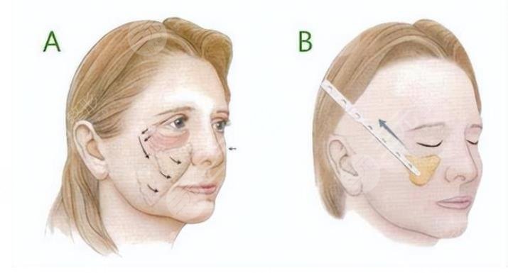深圳協(xié)和醫(yī)院整形科拉皮案例