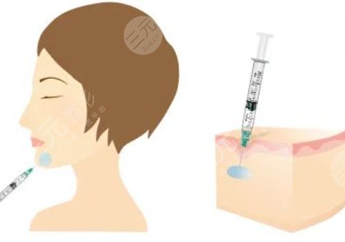 下顎線提升整形有什么做法？