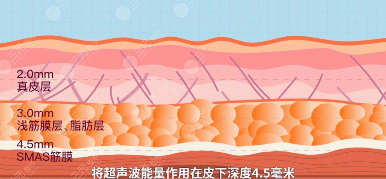 超聲炮抗衰