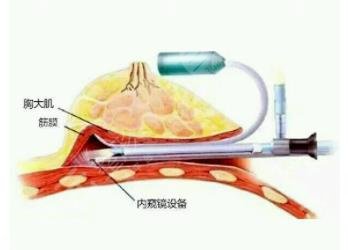 內窺鏡隆胸