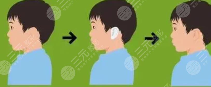 小耳畸形