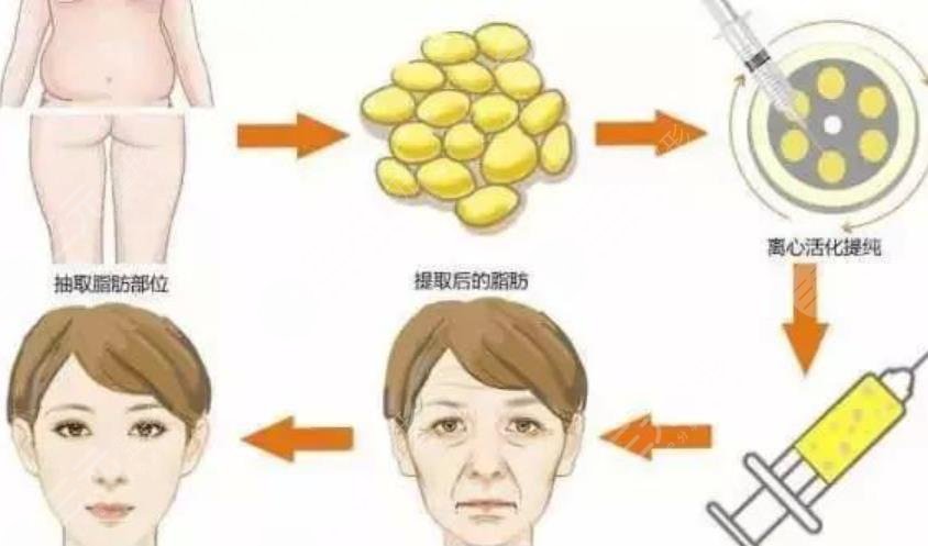 面部填充