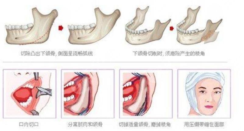 磨骨