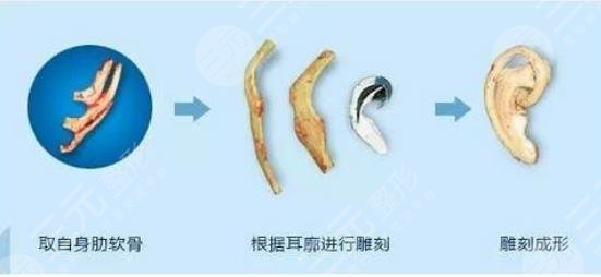 外耳再造手術(shù)需要多少費(fèi)用？?jī)r(jià)格表大全，匯總分享！