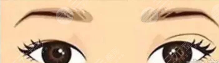 雙眼皮