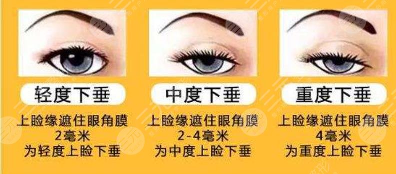 上瞼下垂\