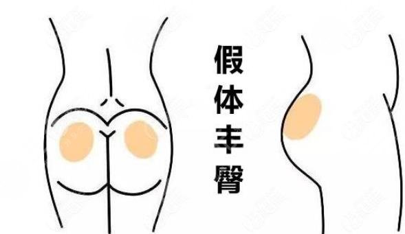 假體豐臀要多少錢？手術(shù)原理及價(jià)格分享，蜜桃美腿指南！