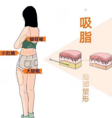 吸脂減肥