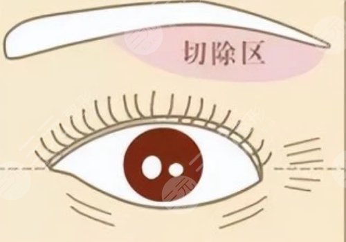 提眉術多久可以恢復自然？