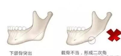 上海九院下頜角手術(shù)注意事項