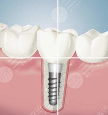 種植牙