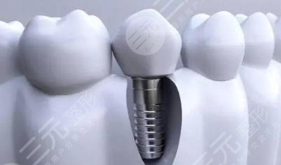 種植牙