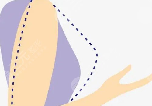 林沸騰醫(yī)生內(nèi)窺鏡隆胸怎么樣？