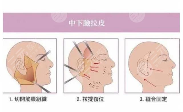 拉皮手術(shù)