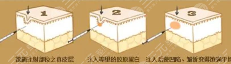 再生型填充