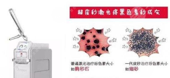 皮秒祛斑