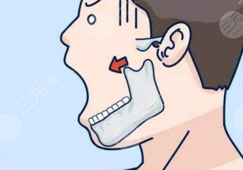 做輪廓手術多少錢費用是多少？