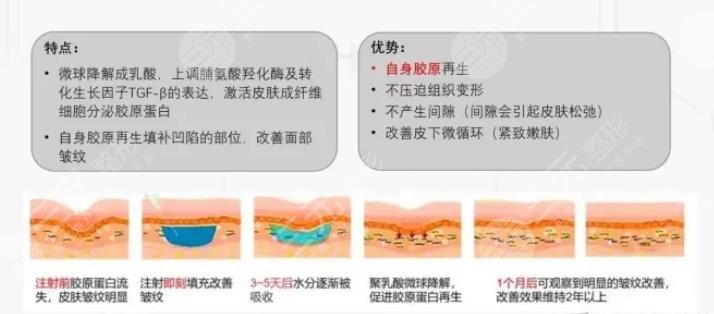 注射艾維嵐多久消腫