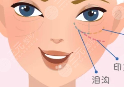 淚溝是怎么形成的？