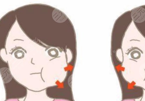 咬肌太大怎么辦如何讓咬肌變小？
