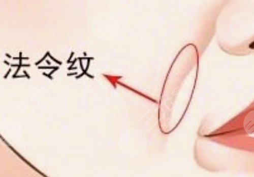 法令紋太深了有什么解決辦法？