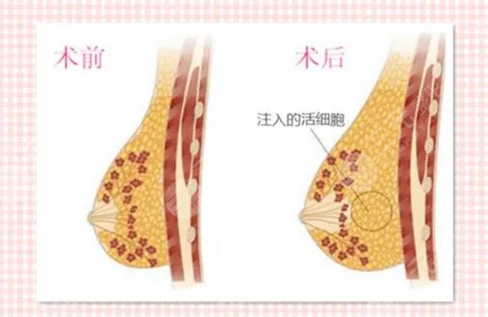 自體脂肪隆胸