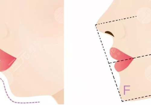 下頜緣提升怎么打？