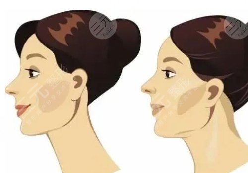 下頜緣提升怎么打？