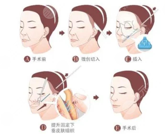 雙矢量提升術多大歲數能做