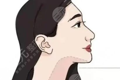下頜緣提升針
