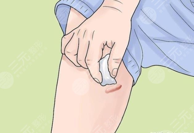 大腿疤痕