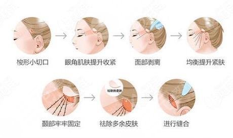 法令紋怎么才能去掉
