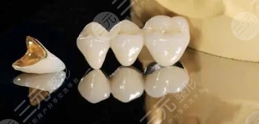 金鈀烤瓷牙價(jià)格一般是多少?