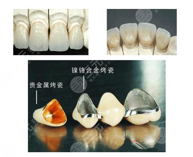 金鈀烤瓷牙價(jià)格一般是多少?