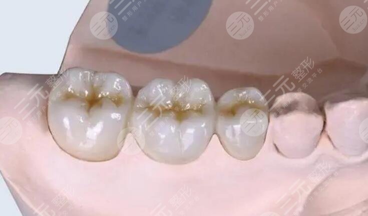 金鈀烤瓷牙價(jià)格一般是多少?