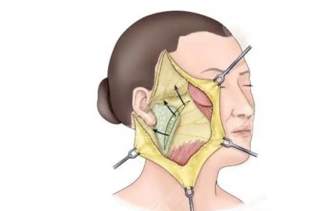 林曉曦面部拉皮手術(shù)案例