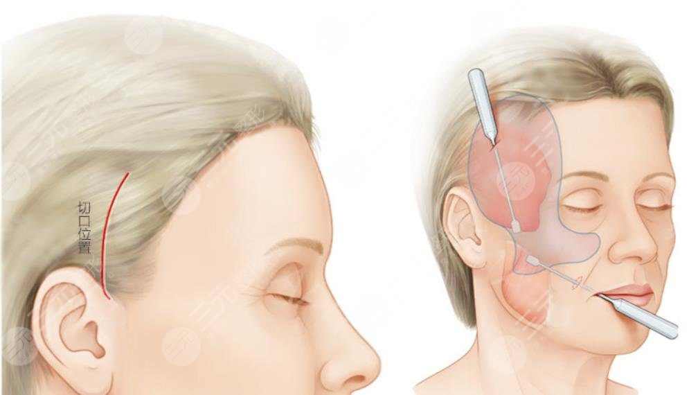 林曉曦面部拉皮手術(shù)案例