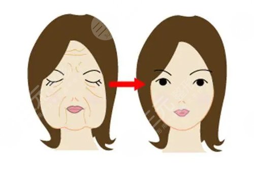 韌帶提升和拉皮的區(qū)別是什么？
