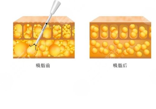 吸脂凹凸不平多久恢復(fù)？
