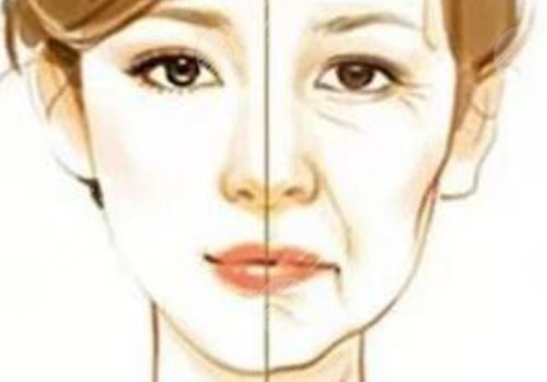 動(dòng)態(tài)紋和靜態(tài)紋哪個(gè)屬于真性皺紋？