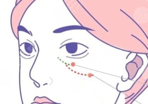 雙美膠原蛋白填充淚溝能維持多久？