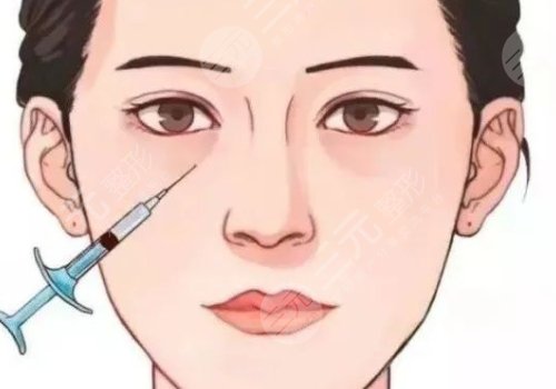 雙美膠原蛋白填充淚溝能維持多久？