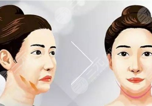 下頜緣提升有什么效果？