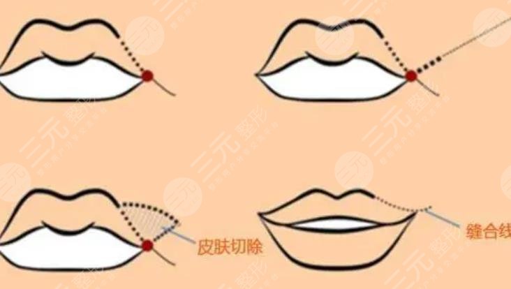 下唇厚外翻整形手術(shù)怎么做？科普及費(fèi)用價(jià)格參考！