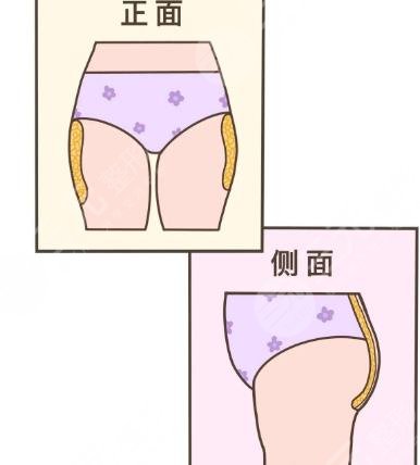 臀部兩側(cè)凸起怎么整形？吸脂體雕助你矯正不美臀型！