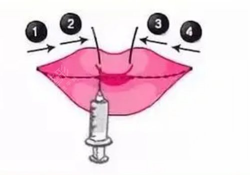 玻尿酸豐唇多久消腫？能維持多久？