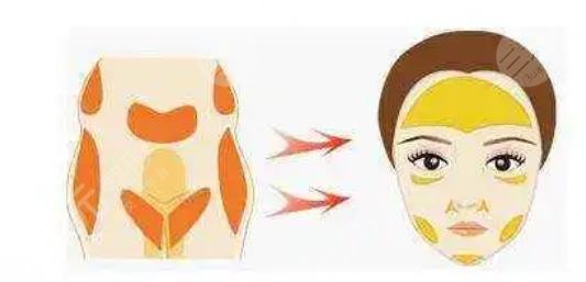 北京亞韓王鳳芹專家脂肪填充面部案例