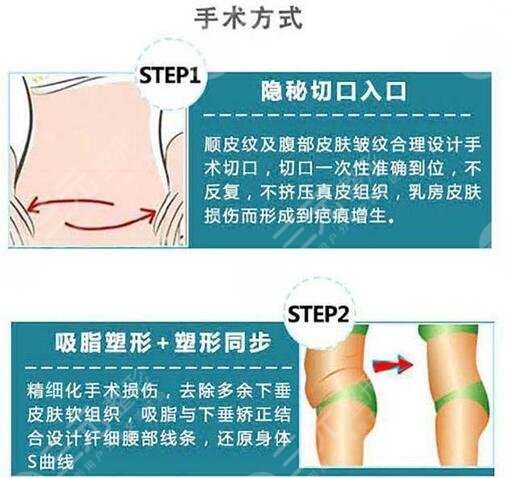 腰腹抽脂腹壁整形恢復期要多久？重塑小蠻腰，這些事你要知道！