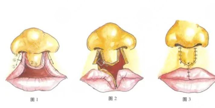唇裂修復(fù)術(shù)