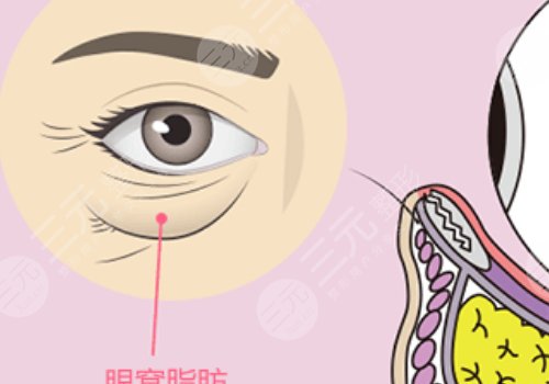 眼窩凹陷用什么填充好？